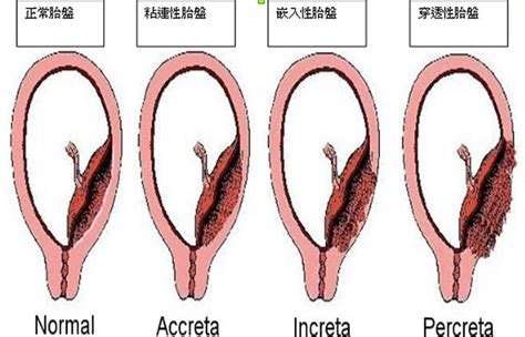 植入性胎盤症狀